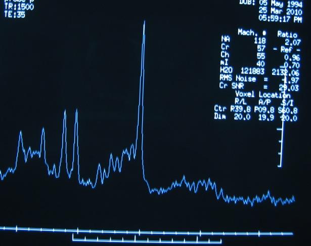 novorojenčka 12 (48) Dojenčki, otroci 13 (52) Kognitivni izid, število (%) Hud razvojni zaostanek 10 (40) Zmerni razvojni zaostanek 5 (20) Blag razvojni zaostanek 4 (16) Normalna kognitivna funkcija