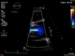 Proximal Jet Ηµιποσοτική µέθοδος Προτιµάται ο