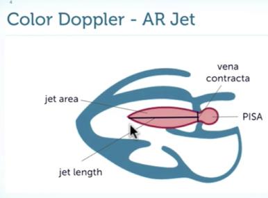 Vena Contracta Είναι το στενότερο σηµείο πρίν το jet της ανεπάρκειας της αορτικής 3