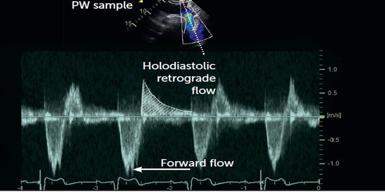 Flow reversal in aorta Ολοδιαστολική αναστροφή στην κατιούσα