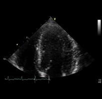 Left Ventricular size and function