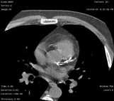 Modalities Carotid Intima