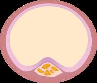σύστηµα Αγγειοχάλαση εξαρτώµενη από το ΝΟ Σε καλλιέργειες ενδοθηλιακών κυττάρων µειώνει την έκκριση του PAI-1