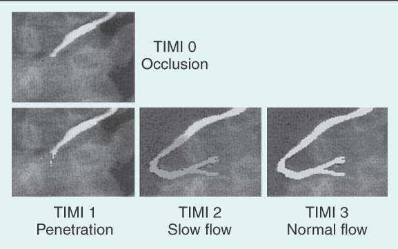 GUSTO-I Angiographic Investigators: Post-lytic TIMI Flow Predicts Mortality P a tie n t M o r ta lity (% ) TIMI Flow 0,1,2 vs TIMI 3 : ~ ΜORTALITY X2