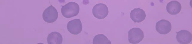 35,36 Αντίστοιχα, η παρουσία σχιστοκυττάρων, κερατοκυττάρων και δακρυοκυττάρων (Εικόνα 2) στην κυκλοφορία του αίματος οφείλεται σε μηχανική καταστροφή των ερυθροκυττάρων.