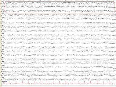 EEG in