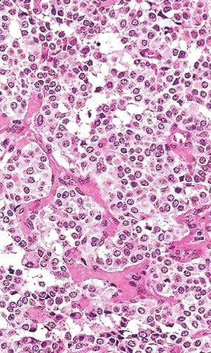 neoplasia type 2 Β, MEN-2Β). Οι διαφορετικοί τύποι οφείλονται στη μετάλλαξη της βλαστικής σειράς του γονιδίου RET.