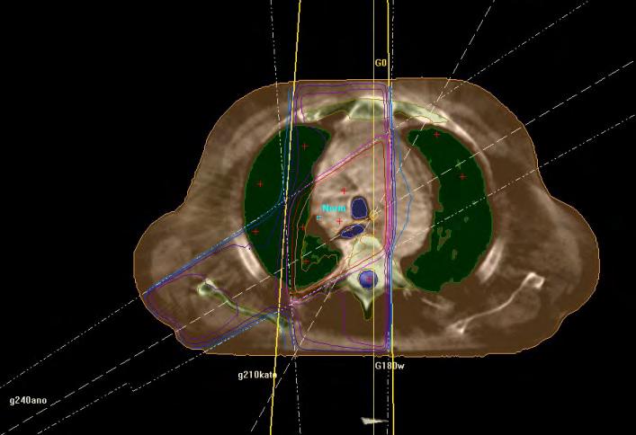o Ασθενής θώρακος Β Για την μελέτη της κατανομής της δόσης στα σημεία ενδιαφέροντος, εφαρμόσαμε ένα πλάνο θεραπείας το οποίο αποτελείται από 4 ισοκεντρικές δέσμες ακτινοβολίας ενέργειας 6MV, και