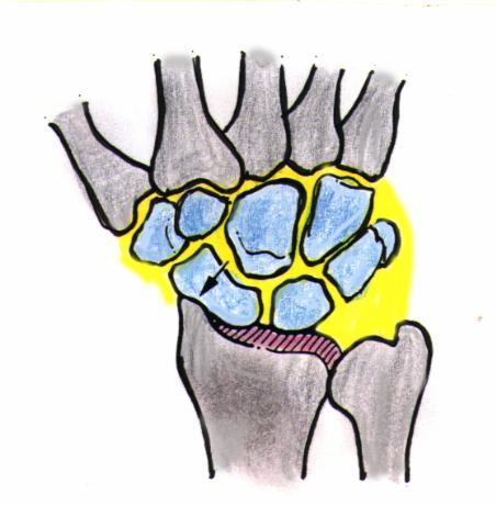 Αιτιολογία Surgical treatment of Scapholunate advanced collapse (Slac wrist) Από την κλινική του Χεριού Μικροχειρουργικής Νοσοκομείου «ΚΑΤ» Δ/της Ν. Δαούτης Δημήτρης Ευσταθόπουλος Χειρ.