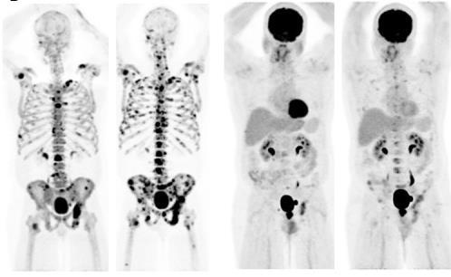 6. PET/CT στον ευνουχοάντοχο ΚαΠ (ΕΚαΠ) 18 F-NaF-PET/CT στον ΕΚαΠ