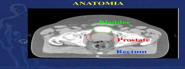 ΤΡΙΣΔΙΑΣΤΑΤΗ ΣΥΜΜΟΡΦΗ ΑΚΤΙΝΟΘΕΡΑΠΕΙΑ Υπόβαλλεται στη συνέχεια σε αξονική τομογραφία σχεδιασμού (planning CT) με τομές 3-5mm από τις λαγόνιες ακρολοφίες μέχρι το περίνεο.