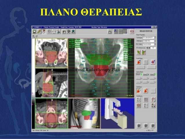 ΤΡΙΣΔΙΑΣΤΑΤΗ ΣΥΜΜΟΡΦΗ ΑΚΤΙΝΟΘΕΡΑΠΕΙΑ Χρησιμοποιώντας *DRRs(digitally reconstructed radiographs)και *EPIDs(electronic portal