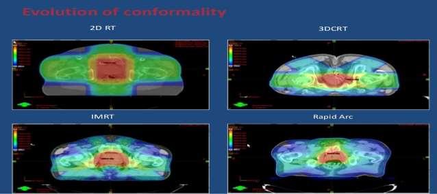 ΡΥΘΜΙΖΟΜΕΝΗΣ ΕΝΤΑΣΗΣ Α/Θ (INTENSITY MODULATED RADIOTHERAPY-IMRT) H ρυθμιζόμενης έντασης ακτινοθεραπεία (IMRT) αποτελεί μια πλέον εξελιγμένη μορφή της τρισδιάστατης σύμμορφης