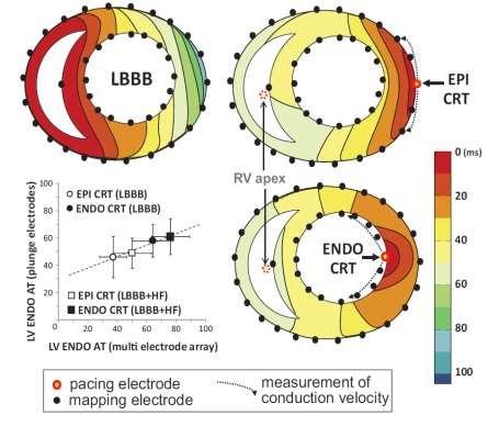 Endocardial Left Ventricular Pacing Improves Cardiac Resynchronization Therapy in Chronic Asynchronous Infarction and Heart Failure Models Ενδοκαρδιακή αγωγή κατά 50% πιο γρήγορη Η διατοιχωματική