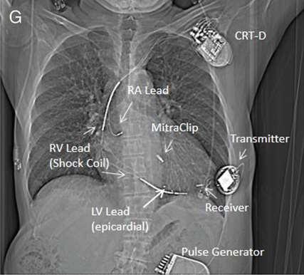 Feasibility, safety, and short-term outcome of leadless ultrasound-based endocardial left ventricular resynchronization in
