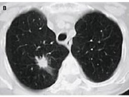 B, spiculated lesion adenoca.