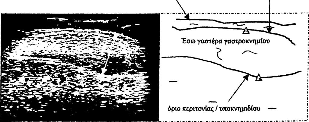 ο π ο π ο ιη μ έ ν ο σ χ ή μ α υπερηχογραφ ικής μελέτης γαστρ ο ιςνημίο υ. Α π ό C h o w,r.s.