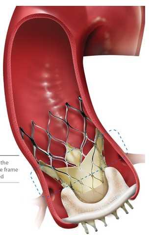 TAVI ΣΕ ΕΚΦΥΛΙΣΜΕΝΗ ΒΙΟΠΡΟΣΘΕΤΙΚΗ ΒΑΛΒΙΔΑ Δεν χρειάζονται εξετάσεις και λεπτομερής απεικόνιση προ της εμφύτευσης δεδομένου ότι το μέγεθος της βαλβίδας-tavi καθορίζεται από το μέγεθος της