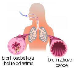 5. Patofiziologija bronhalne astme Astmatiĉni napadaj karakteriziraju promjene plućne funkcije i izmjene plinova.