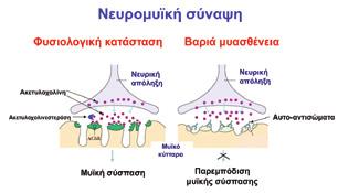 ΕΠΙΣΤΗΜΟΝΙΚΗ ΕΠΙΣΚΟΠΗΣΗ Εικόνα 1. Δομή της νευρομυϊκής σύναψης σε φυσιολογική κατάσταση και στη βαριά μυασθένεια.
