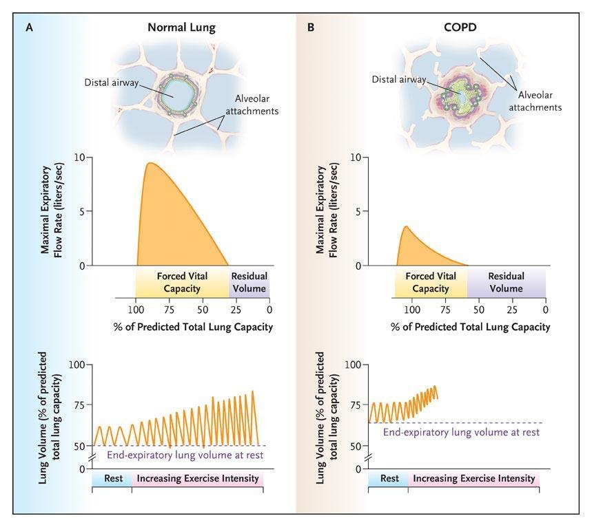 Pathophysiological Features of Airflow Obstruction in