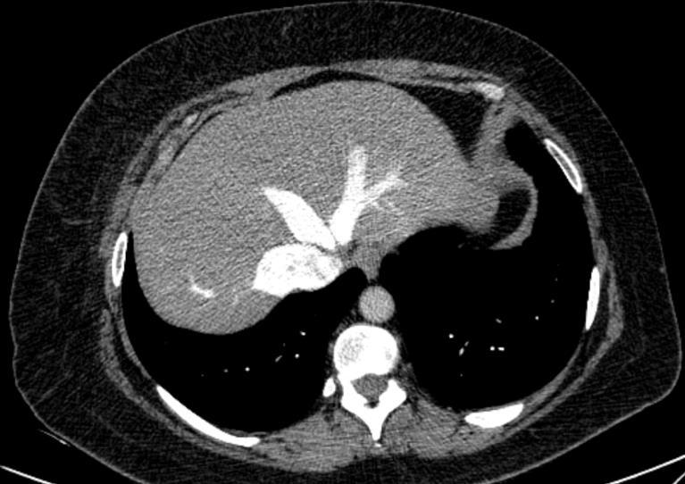 and 1. Pericardial effusion 2.