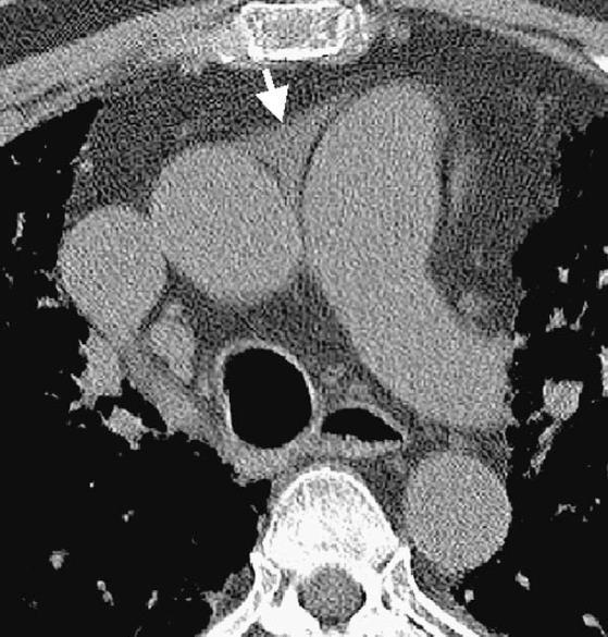 of CM to IVC and hepatic veins 3.