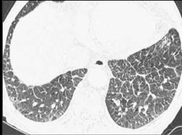 valve disease In