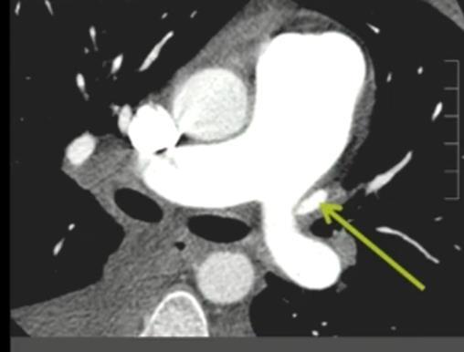 PAWP (< 15 mmhg)