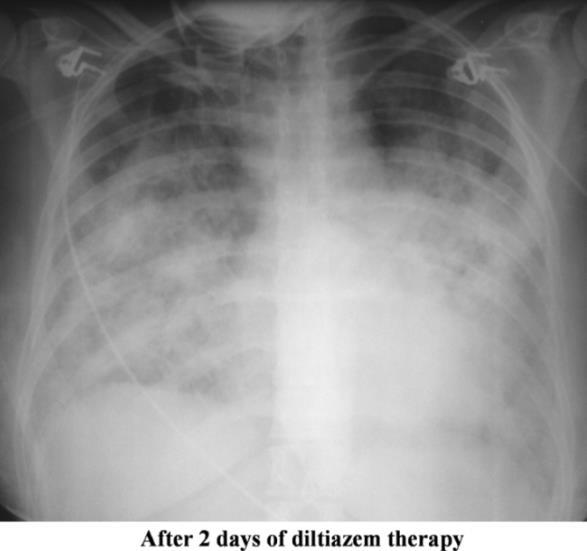 GROUP 1Ꞌ : PVOD/PCH Rare, difficult to diagnose But, no room for