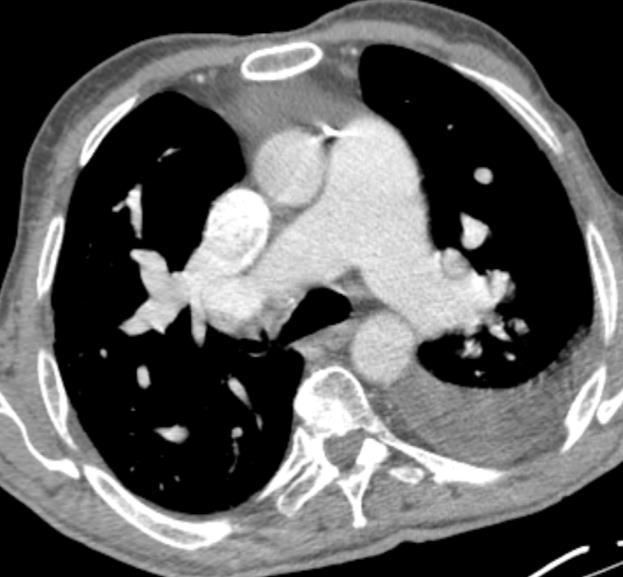 Chest CT for pneumonia Some malformations, such as patent