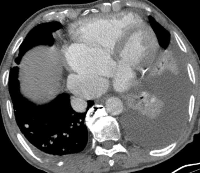 partial anomalous pulmonary venous return, are often concealed