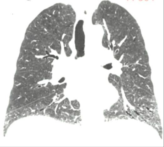 Infiltrative lung