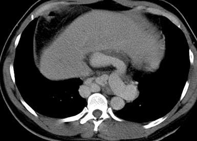 splenomegaly, esophageal