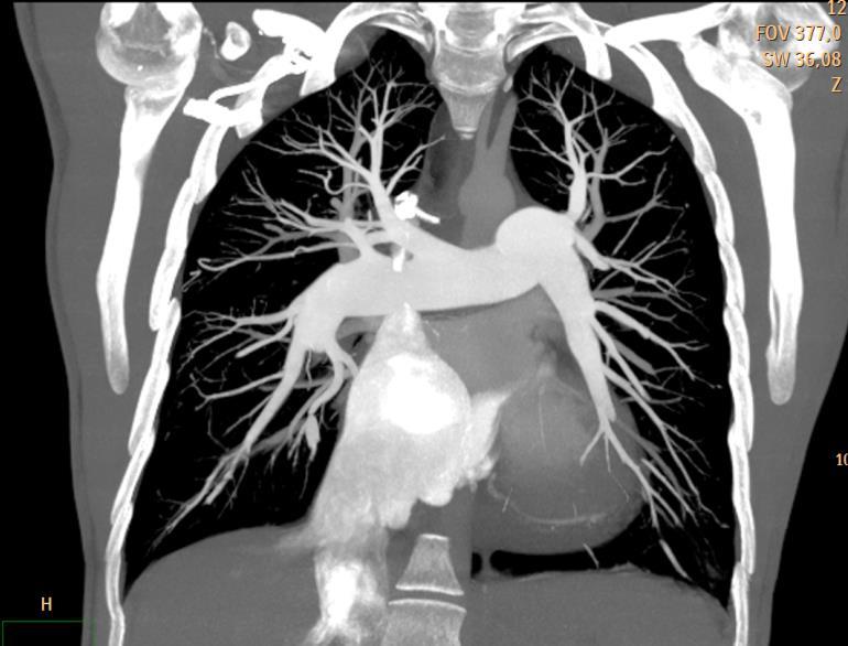 Pulmonary Hypertension CT Protocol High Resolution CT : Inspiratory Expiratory Computed Tomography Pulmonary Angiography (CTPA) IPAH CTEPH Γρήγορες σαρώσεις ( 4-12 sec) μετά IV έγχυση ιωδιούχου