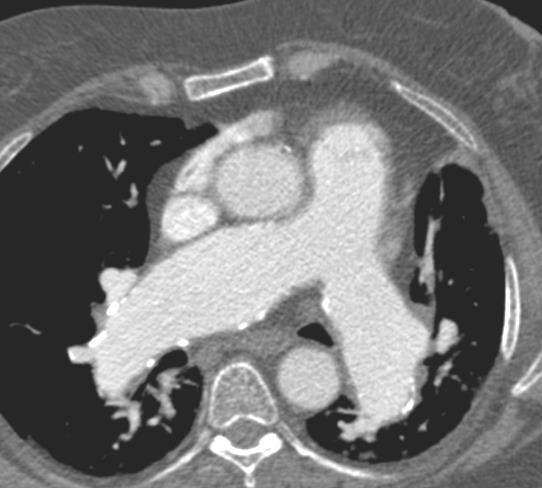 Mimics of CTEPH Eisenmenger's syndrome and PH due to portal hypertension can