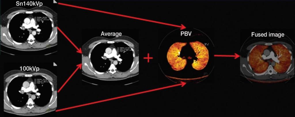 Dual Energy CT- Lung Perfusion Dual-energy CT pulmonary angiography allows the generation blood volume (PBV) maps that represent the relative iodine concentration in the lung parenchyma, which is a