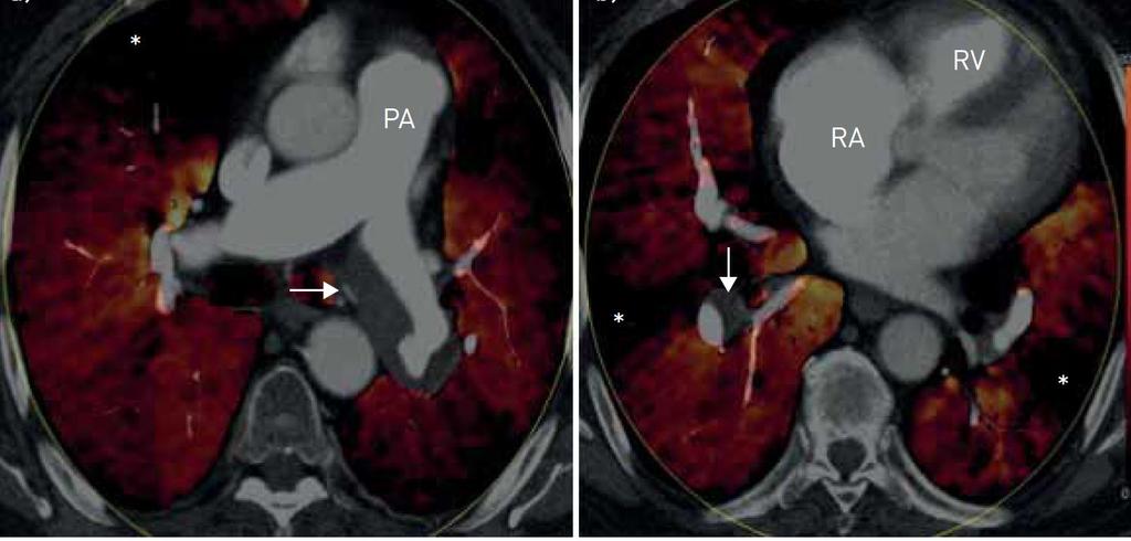 Dual Energy CT- Lung