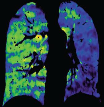 Multi Detector CT ADVANCES ECG Gated MDCT Assessment of RV functional parameters when the patient is unable to undergo MRI Iterative