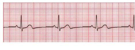 Διπλωματική εργασία: Παπαδάκης Ματθαίος. 1.4 Παθήσεις της καρδιάς Στην παρούσα ενότητα θα αναφερθούν οι σημαντικότερες παθήσεις-ασθένειες που εμφανίζονται στην καρδιά. 1.4.1 Φλεβοκομβική βραδυκαρδία Η βραδυκαρδία σημαίνει μικρότερη συχνότητα λειτουργίας της καρδιάς, μικρότερη δηλαδή από 60 (BPM) παλμούς ανά λεπτό [8,12].