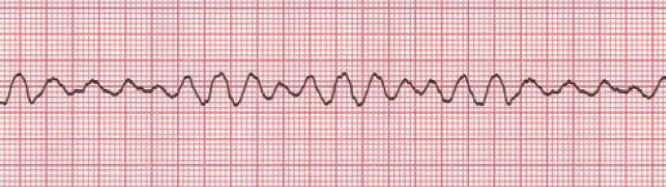 Διπλωματική εργασία: Παπαδάκης Ματθαίος. άλλα είναι σε πλήρη χαλάρωση οπότε στην ουσία δεν υπάρχει καρδιακό ρυθμός όπως φαίνεται και στο σχήμα 1.4.