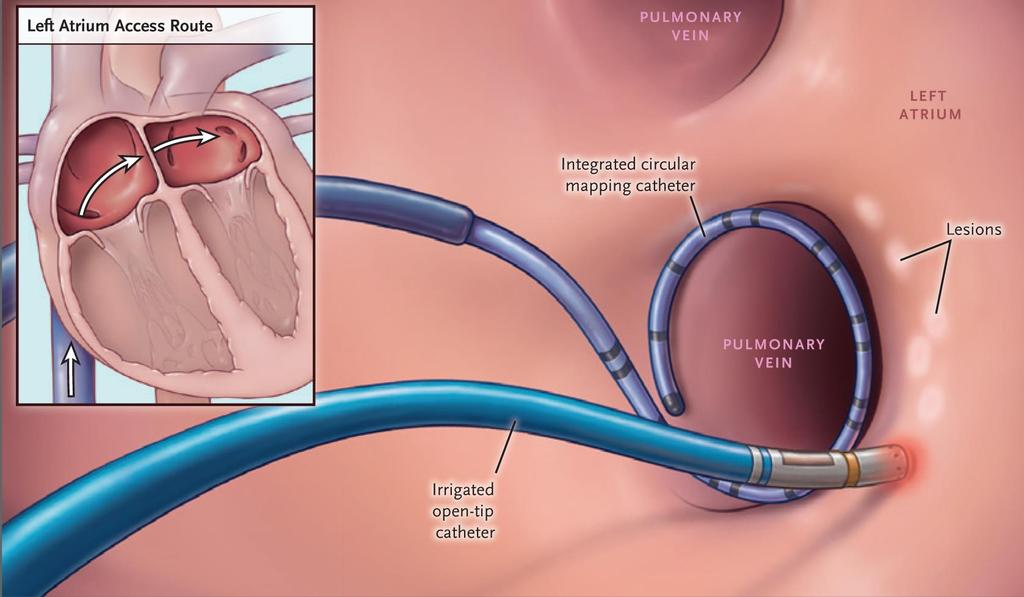 Catheter AF