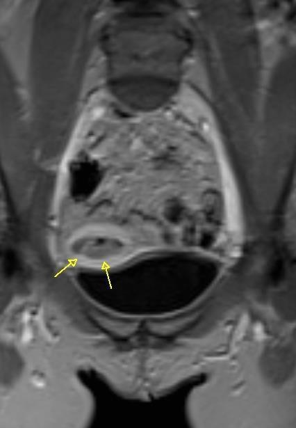 Σταδιοποίηση MRI πυέλου : Μάζα 39 x 15 mm,που καταλαμβάνει σχεδόν ολόκληρη την ενδομητρική κοιλότητα Διήθηση μυομητρίου < 50% Ύποπτοι