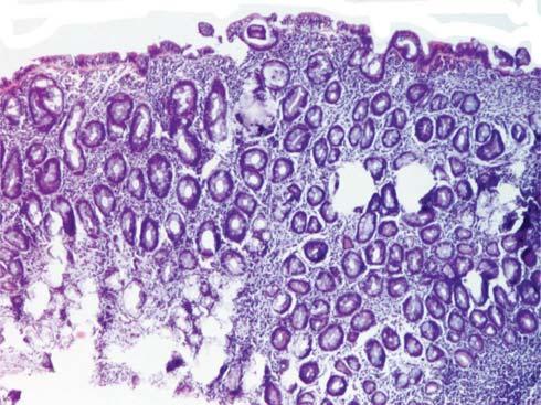 468 REVISTA ROMÂNÅ DE PEDIATRIE VOLUMUL LXIV, NR. 4, AN 2015 inapetenţă, dureri abdominale recurente, stagnarea creşterii ponderale.