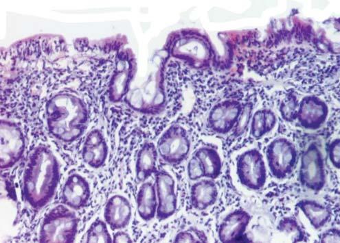 REVISTA ROMÂNÅ DE PEDIATRIE VOLUMUL LXIV, NR. 4, AN 2015 469 limfo-plasmocitar în corion, numeroase lim focite intraepiteliale în lamina propria aspect su gestiv pentru MARSH IIIB.