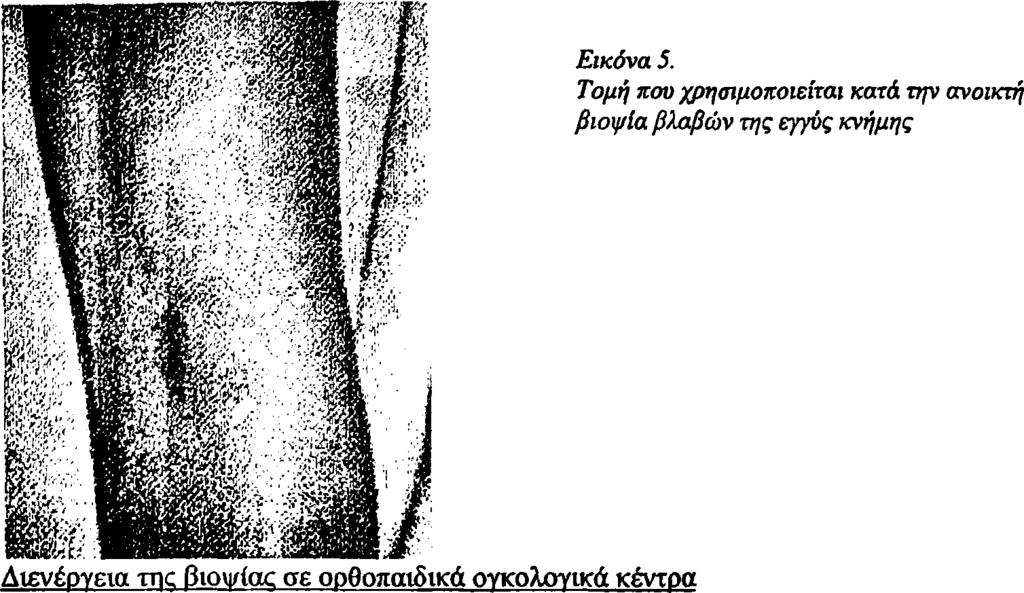 Η τομή θα πρέπει να τοποθετηθεί κάτω από το επίπεδο της άρθρωσης του γόνατος. Θα πρέπει επίσης να τοποθετηθεί στην ίδια κατεύθυνση όπου θα διενεργηθεί και η τομή για την εξαίρεση του όγκου.