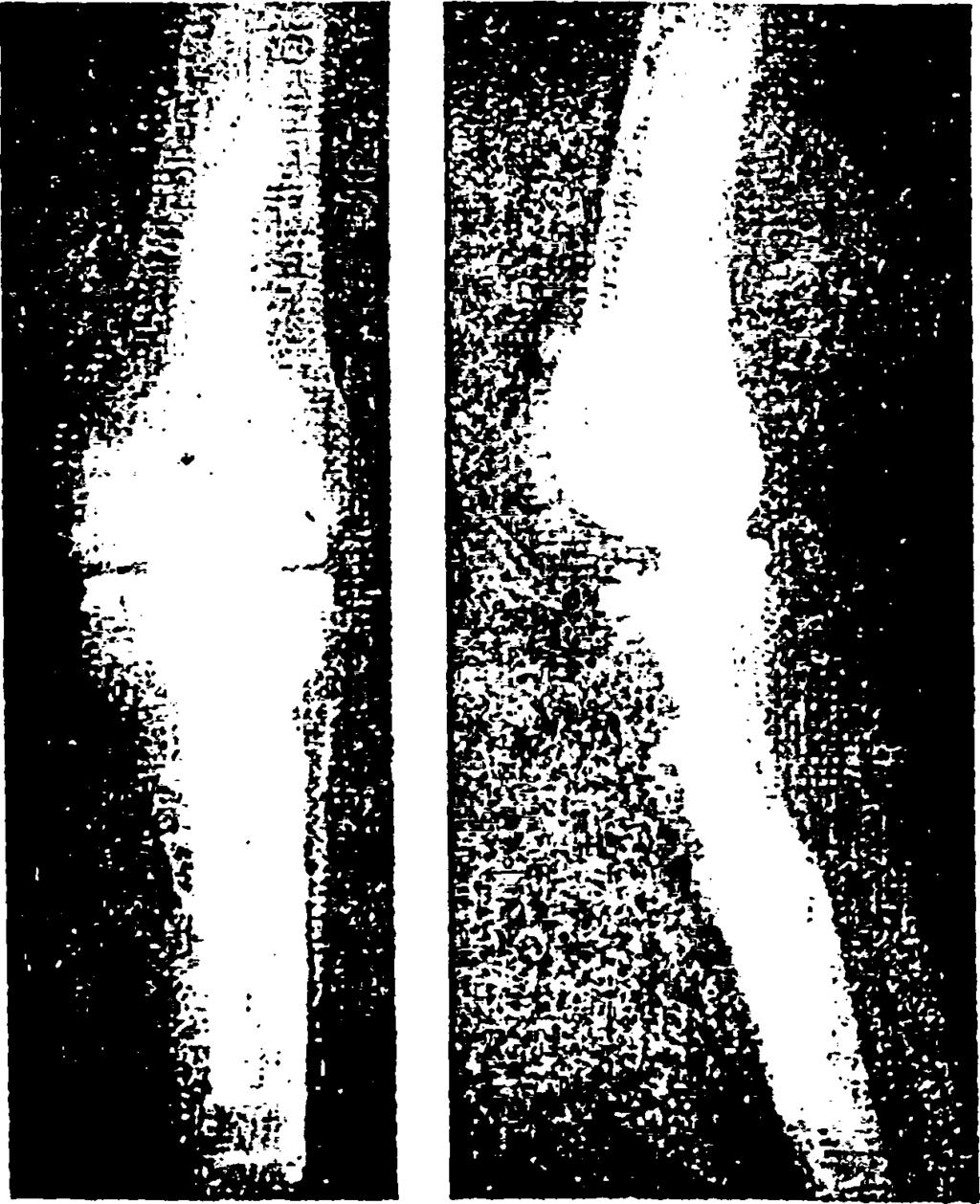 Οι πλάγιοι σύνδεσμοι μπορούν να αποκατασταθούν, εάν όμως αυτό δεν είναι δυνατόν, τότε θα πρέπει να χρησιμοποιηθεί ειδική ολική αρθροπλαστική γόνατος (constrained).