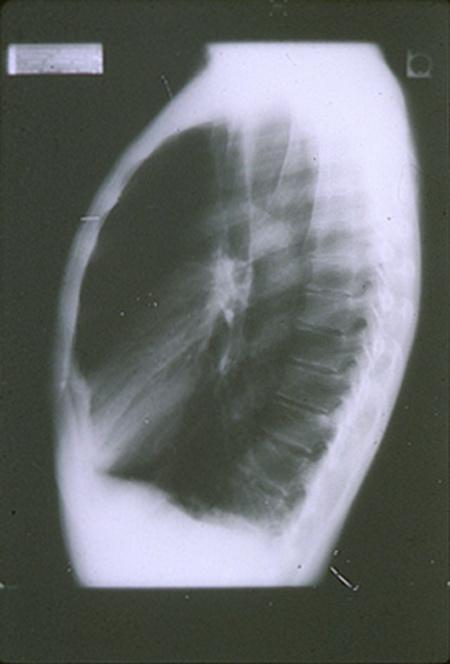 Reduced expiratory