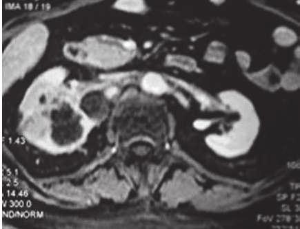 The role of transanterial embolization of the renal cell carcinomas (RCC) in elderly A B Figure 1 (Α, Β): Transverse and sagittal T1 - weighted contrast material - enhanced fat - suppressed magnetic