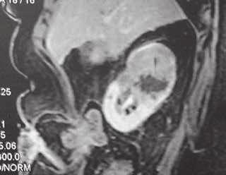 post-chemoemboliazation (B), depicting the extensive lesion necrosis as non-opacified ent vessel.